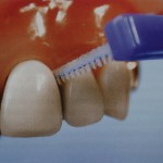 Oral Care After Dental Implant Procedure. Cleaning Dental Implants …